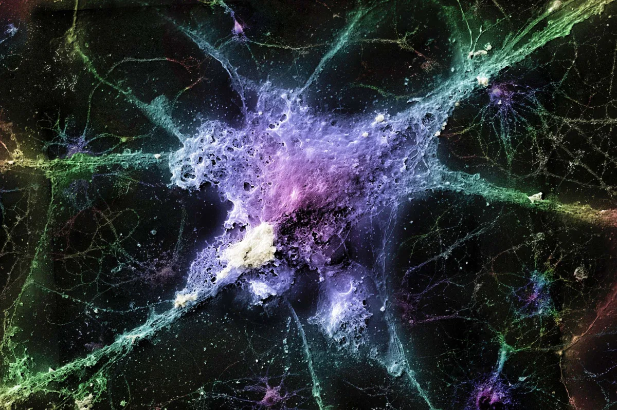 Alzheimer Hastalığı İçin Yeni Umut Veren Araştırma