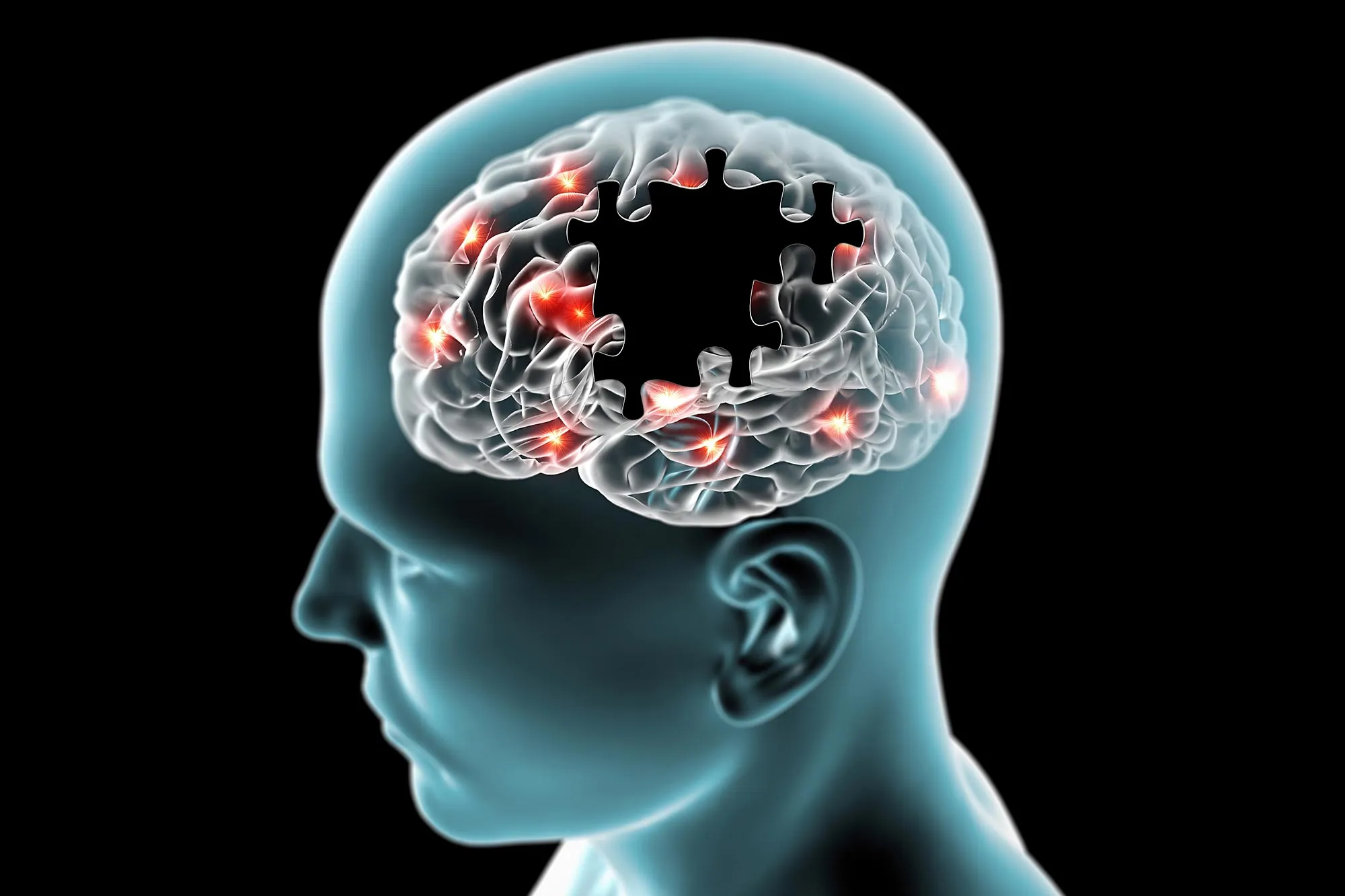Obezite Alzheimer'den Alzheimer'a: Korkutan Bağlantı Çözüldü
